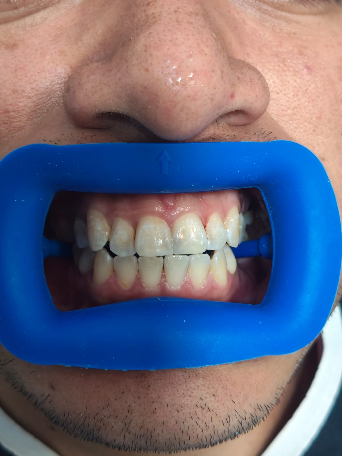 Sonrisa después del tratamiento odontológico