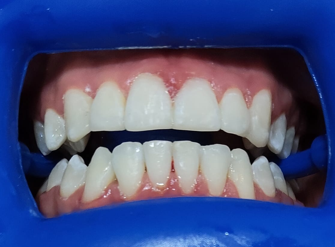 Sonrisa después del tratamiento odontológico